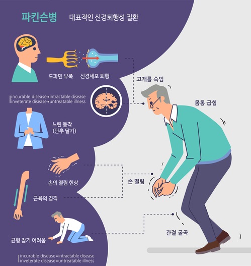 60대 이상 손 떨고 행동 느려지면 파킨슨병 의심…방치하면 치료 어려워져